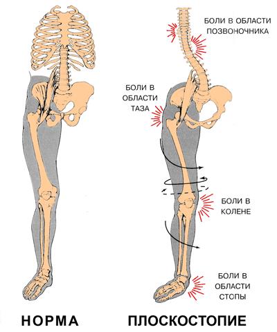 Ортопедические стельки